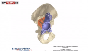 mobilelife-cad-model-for-3D-printed-hip-replacement