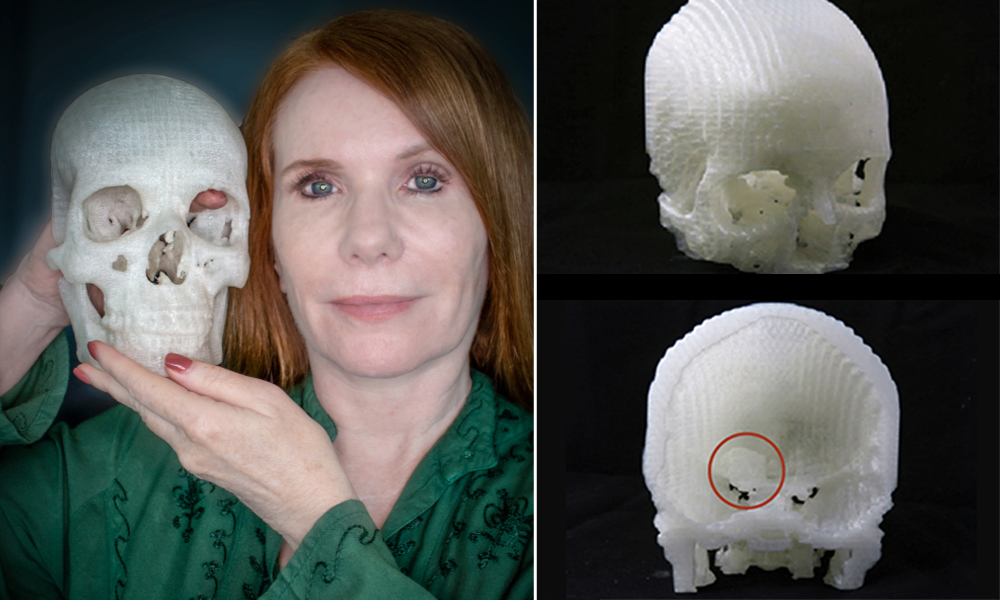 Homem recebe primeira prótese de olho totalmente impressa em 3D